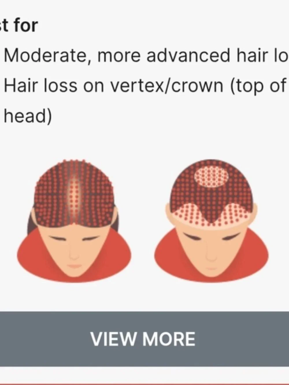 LaserCap HD for Hair Growth